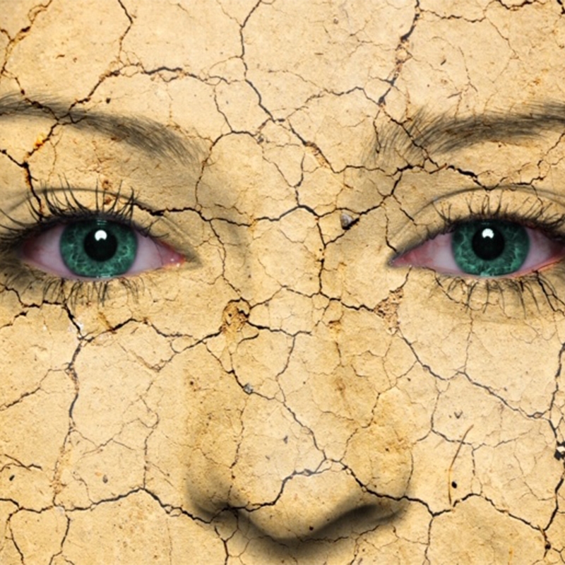 Sjögren’s Syndrome